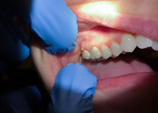 Best Emergency Denture Repair in Hendersonville, TN