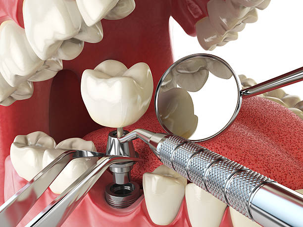 Best Emergency Root Canal Treatment in Hendersonville, TN